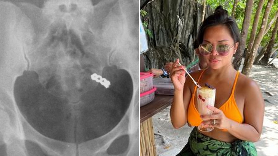 Woman accidentally swallows wedding ring while taking vitamins, X-ray shows