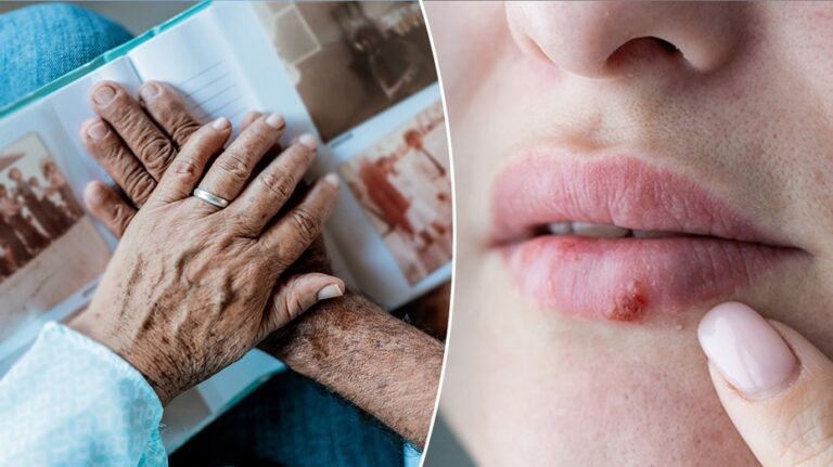Cold sores may play role in Alzheimer's development, new research reveals