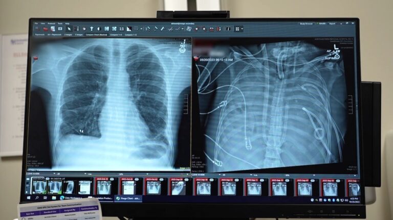 Surgeons keep man alive without lungs, paving new path to transplant