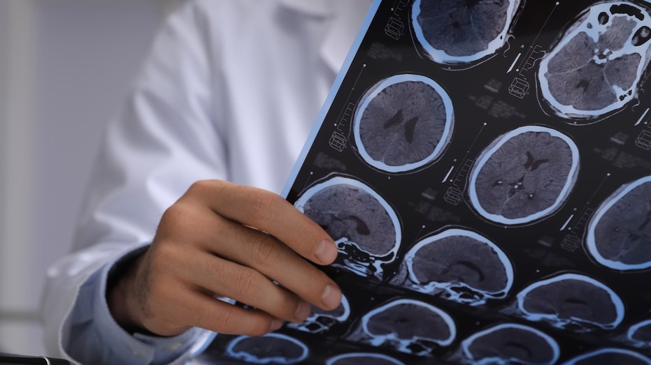 Doctors thought man had brain cancer — they found live tapeworms instead